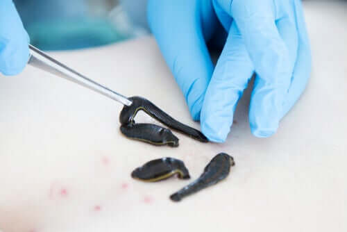 Terapia con le sanguisughe