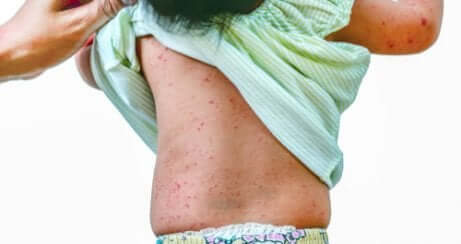 Eruzioni cutanee diffuse su tutto il corpo sono uno dei sintomi della febbre maculosa.